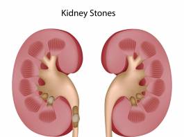 kidney Stone Problem