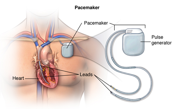 Pacemakers – Facts and Details