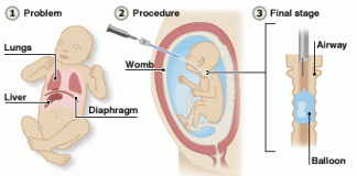 Pneumothorax in Premature Babies
