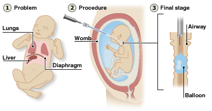 Pneumothorax in Premature Babies – Definition, Causes and Treatment