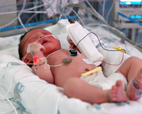 Respiratory Syncytial Virus : Symptoms and Prevention for RSV in Premature Babies