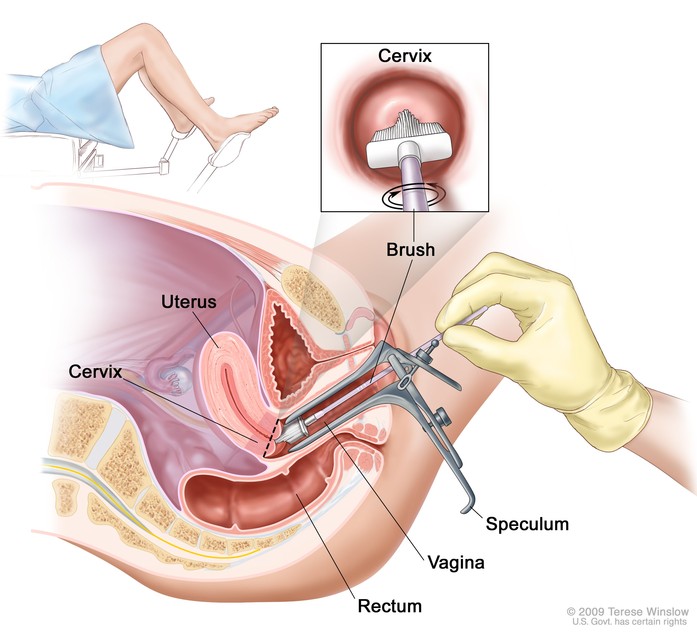 Understanding Pap Smear Tests in Women