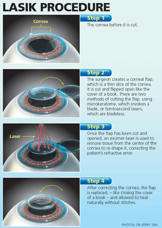 LASIK Surgery: Positive and Negative Effects