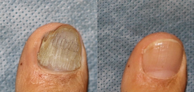 Laser Treatment: A Solution for Your Toenail Fungus