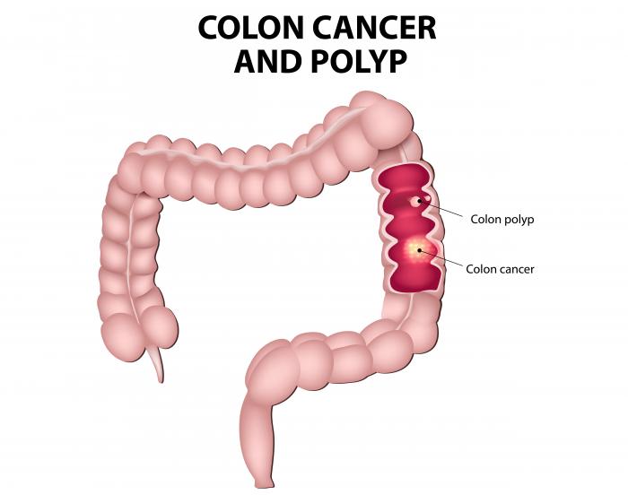 Colon Cancer: Stages and its Basics
